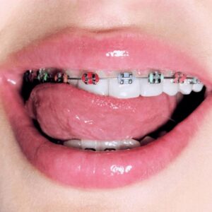 Брекеты (Braces)